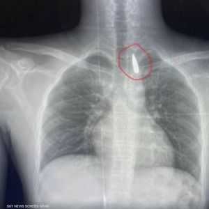 حالة المريض مستقرة حاليا وتحت المتابعة الدقيقة