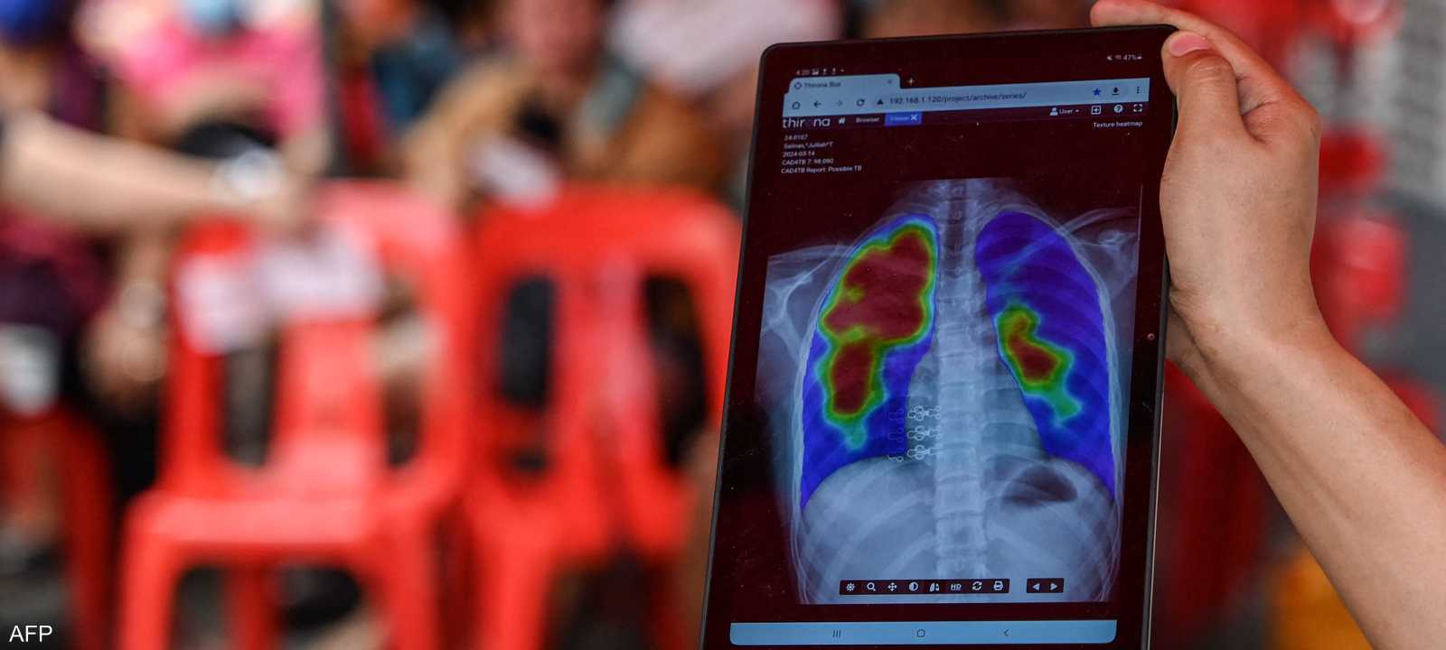 أشعة سينية أثناء فحص مرض السل_أرشيف