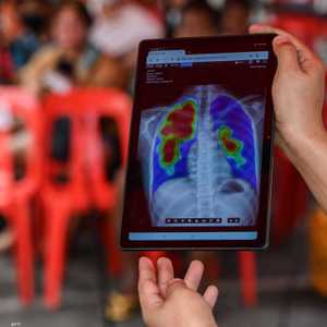 أشعة سينية أثناء فحص مرض السل_أرشيف