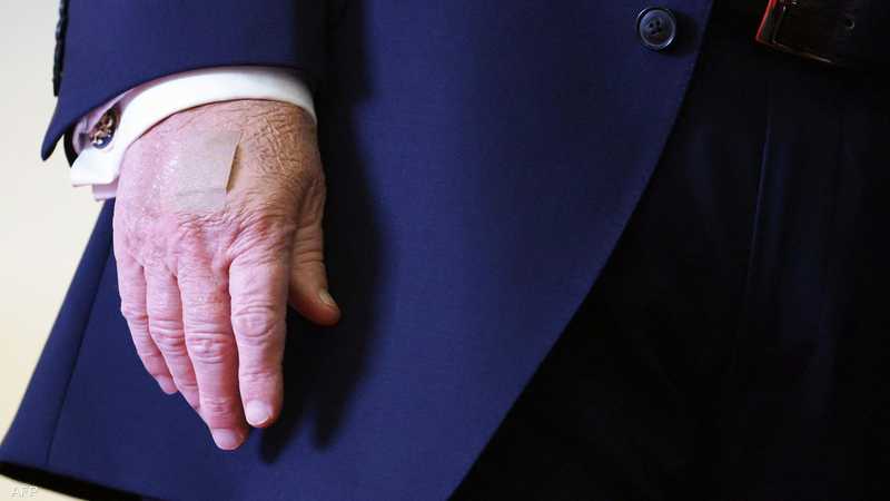 كدمات جديدة على يد ترامب