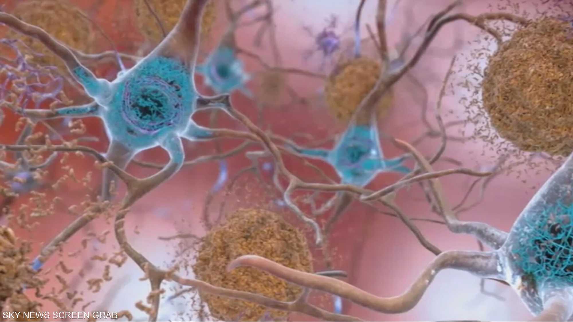 نتائج مخبرية تفتح باب الأمل لعلاج ألزهايمر