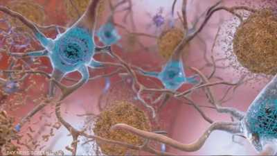 نتائج مخبرية تفتح باب الأمل لعلاج ألزهايمر