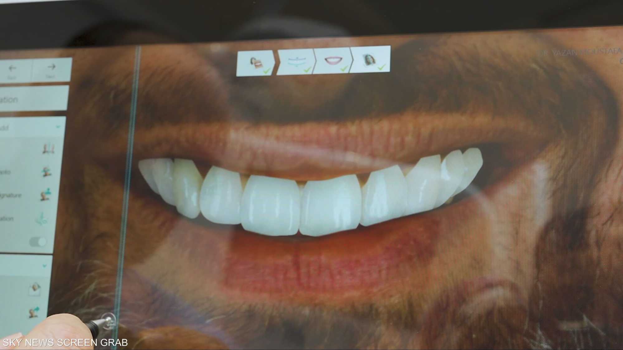 تقويم الأسنان.. حل مؤقت أم طويل الأمد