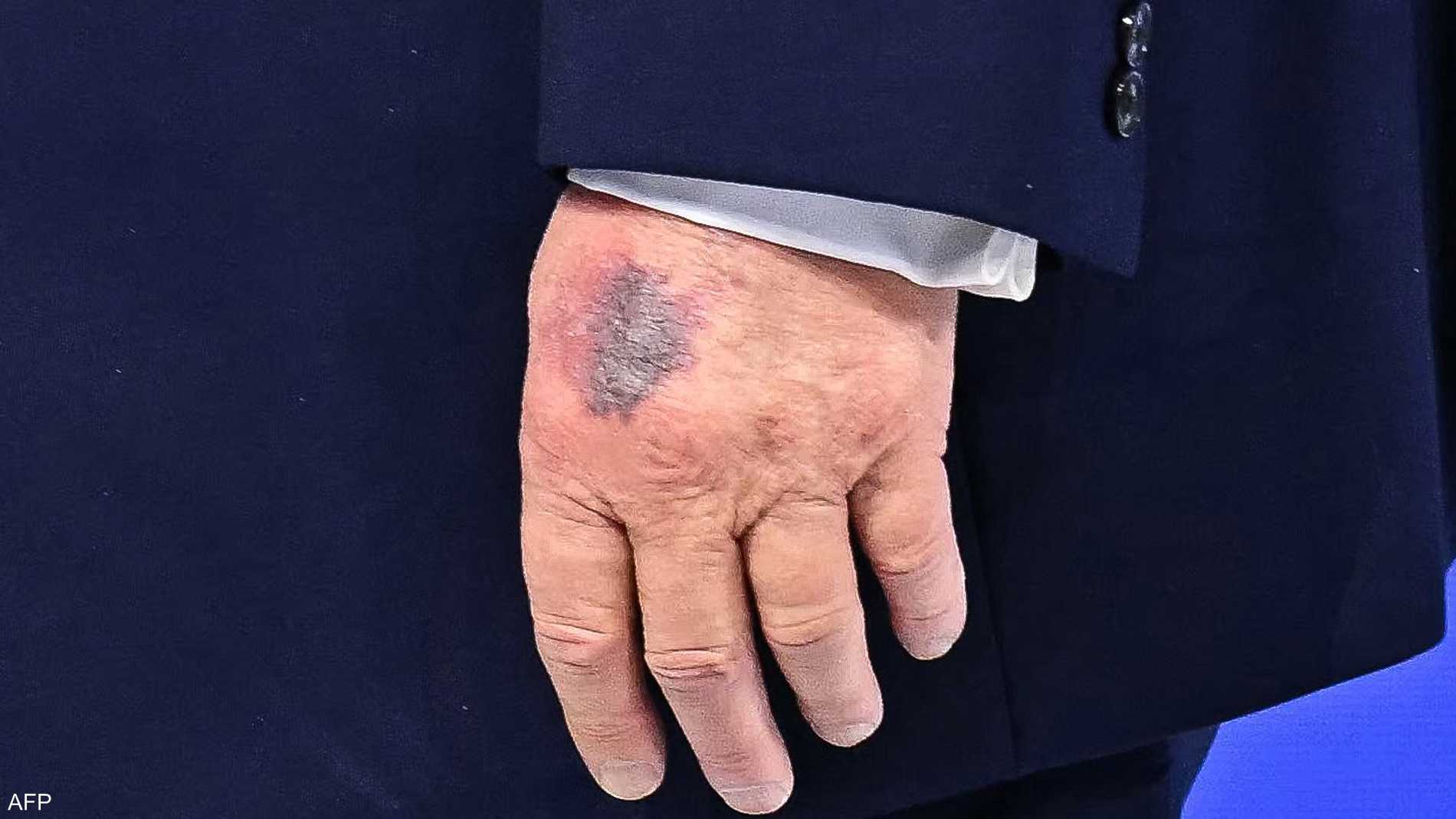 ترامب يكشف سبب "أحدث كدمة" تظهر على يده 