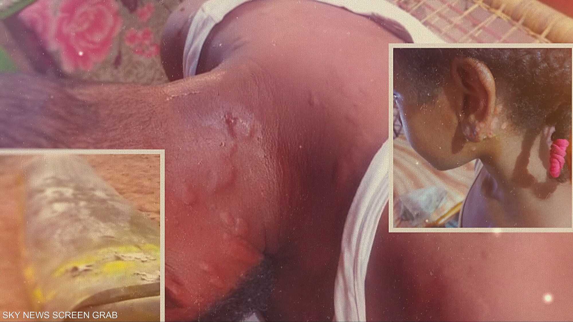 تحقيق حصري.. جرائم الكيماوي في السودان.. الحقيقة المخفية