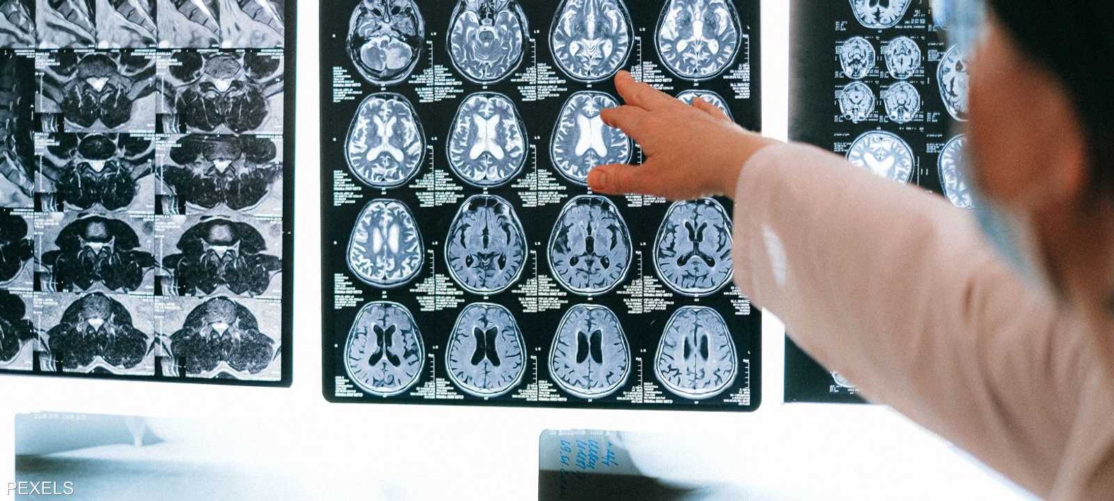 دراسة تكشف سر حماية الدماغ من التدهور المعرفي