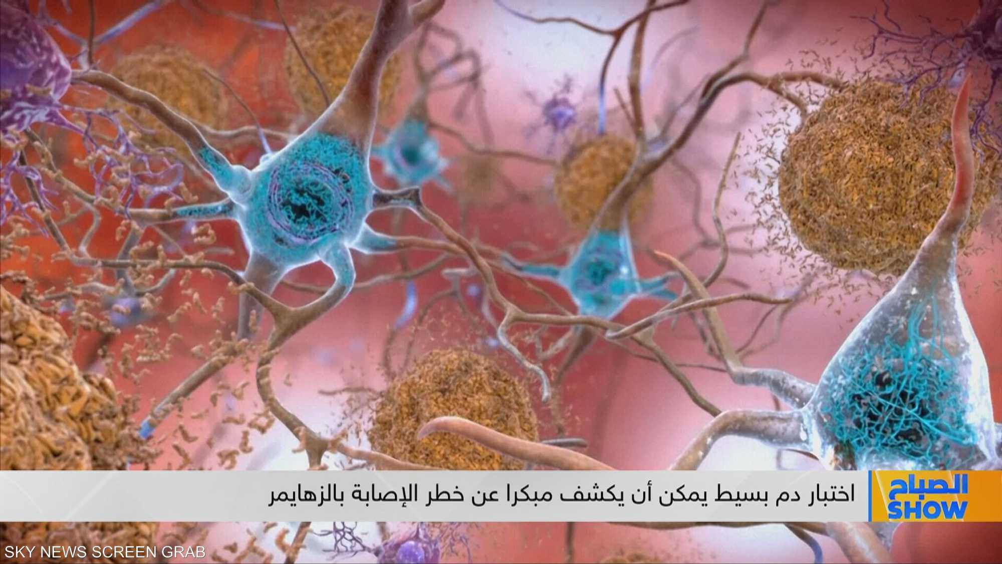 اختبار دم بسيط يمكن أن يكشف مبكرا عن خطر الإصابة بالزهايمر
