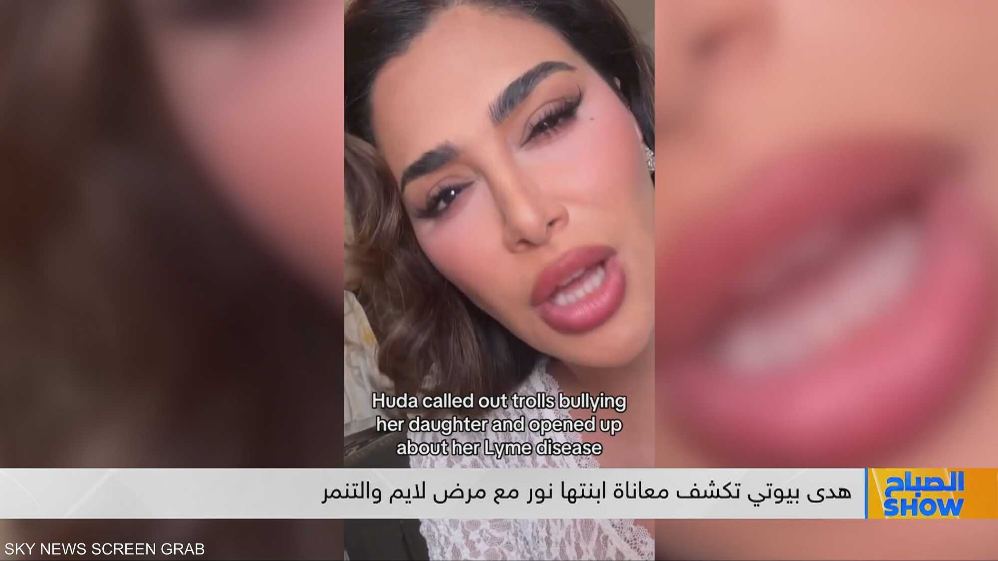 هدى بيوتي تكشف معاناة ابنتها نور مع مرض لايم والتنمر