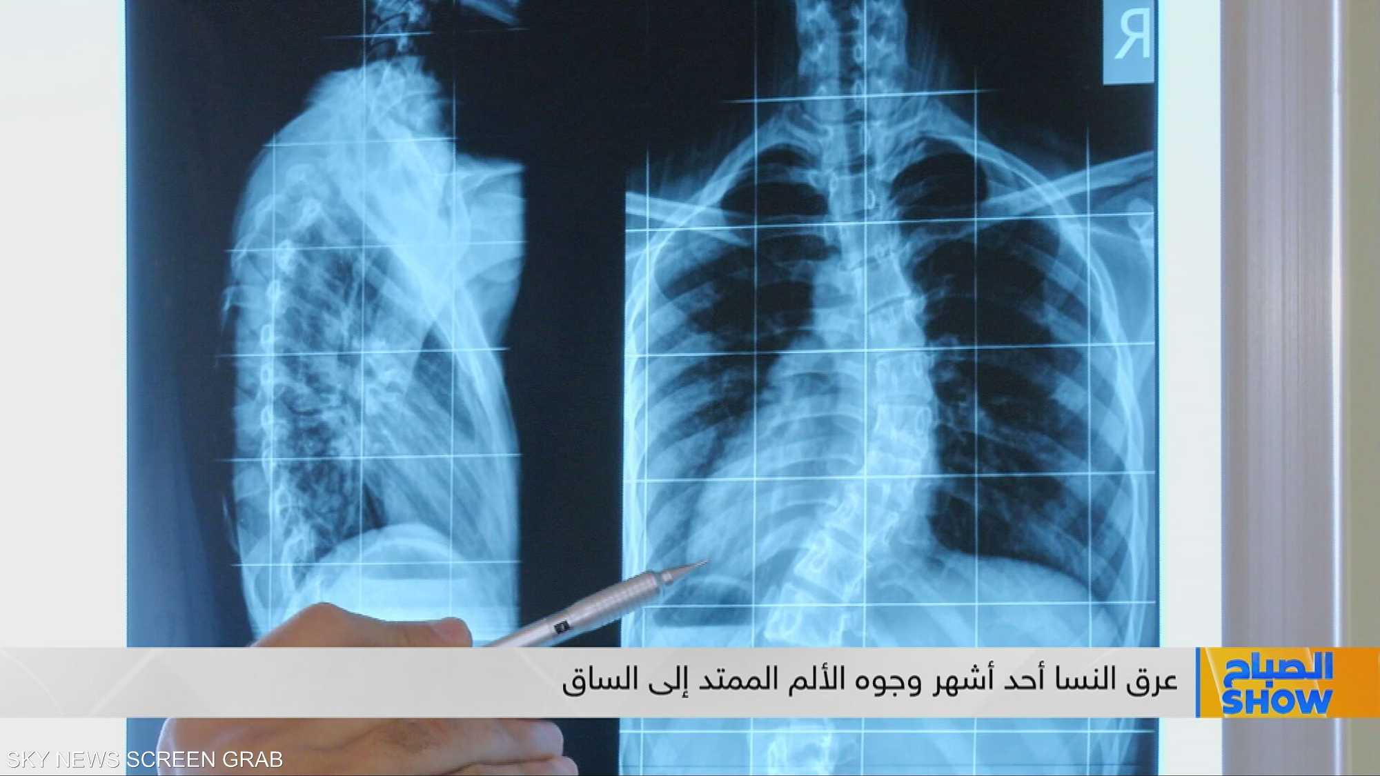 عرق النسا.. ألم حارق قد يشل حركتك