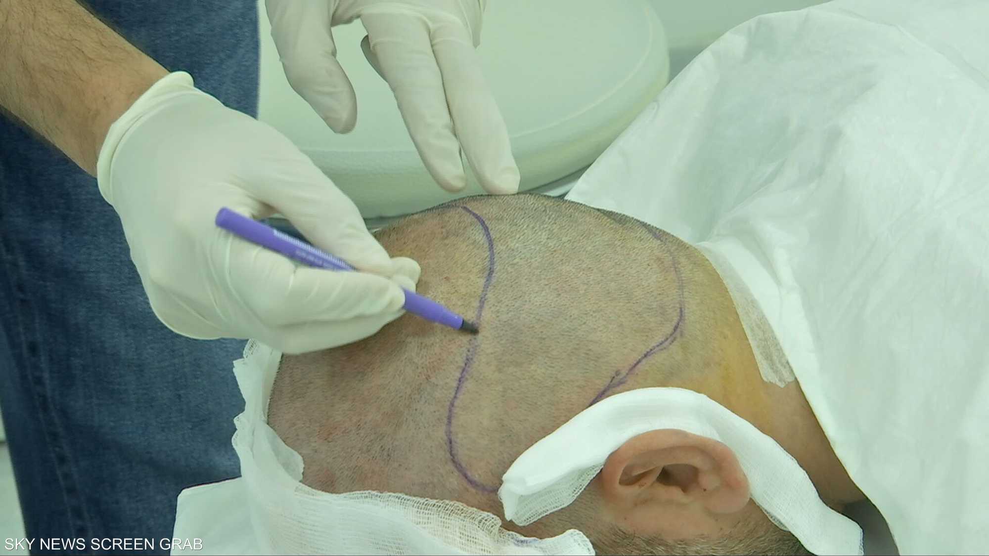 جلسة واحدة فقط.. زراعة الشعر تدخل عصر السرعة