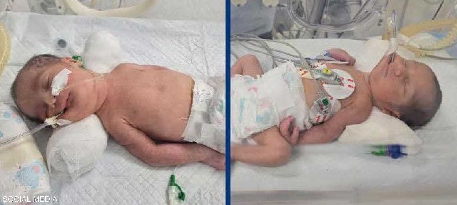 تم إنقاذ الطفلين بعد موقف طبي معقد