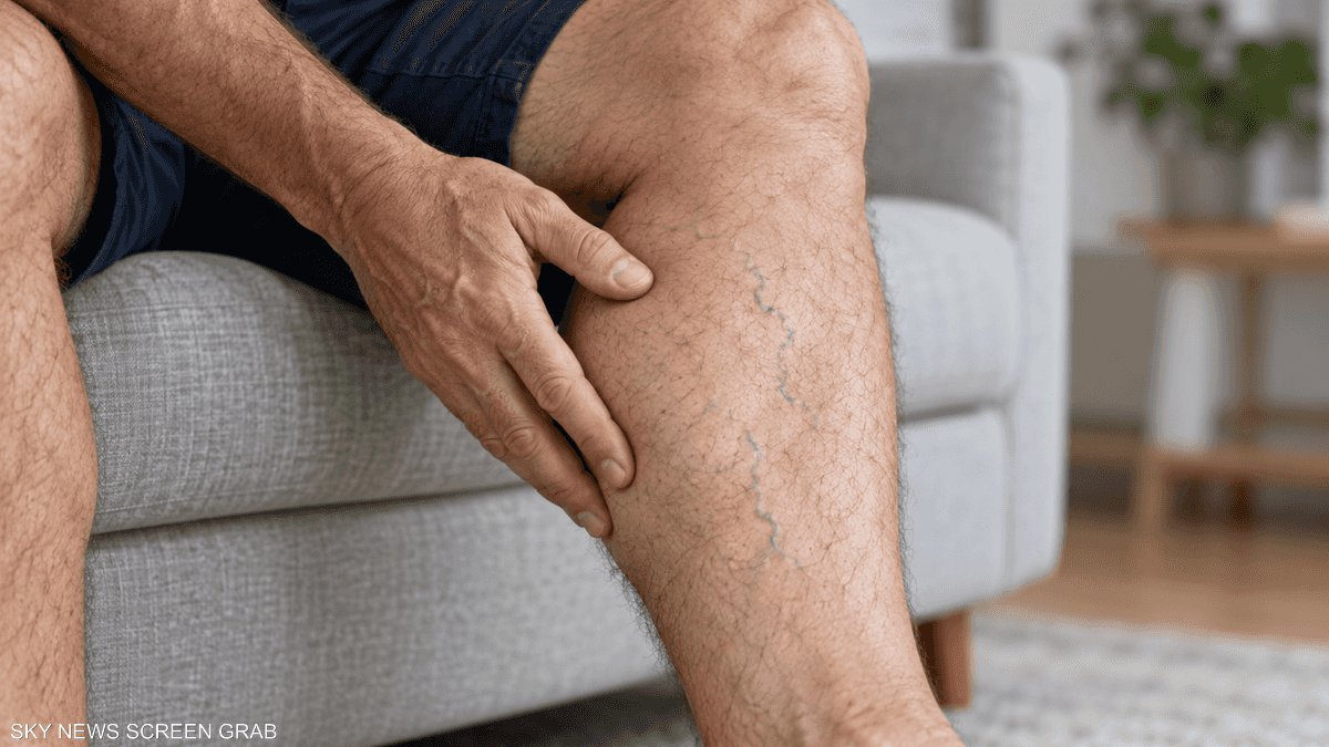 هل وضع ساق فوق أخرى يسبب دوالي الساقين؟