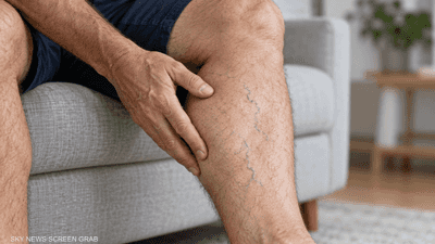 هل وضع ساق فوق أخرى يسبب دوالي الساقين؟