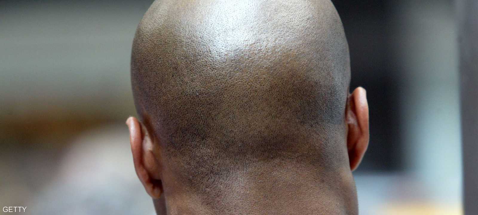 علاج جديد للصلع وتساقط الشعر والشيب