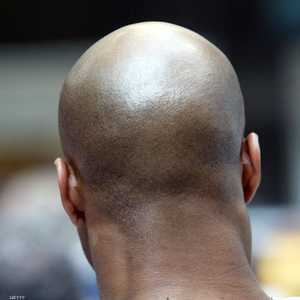 علاج جديد للصلع وتساقط الشعر والشيب