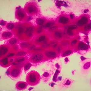 الخلية قادرة على القضاء على معظم أنواع من السرطان