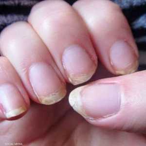مشكلات الأظافر قد تكون مؤشرا على أمراض كثيرة.