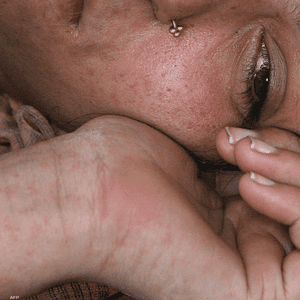 صورة لامرأة مصابة بطفح جلدي. (تعبيرية)