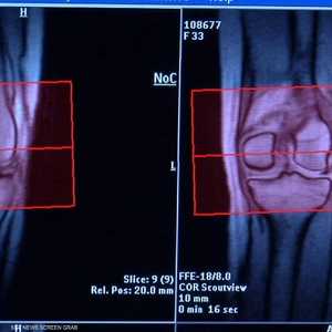 ينصح بالمواظبة على التمارين المائية للحد من آلام المفاصل