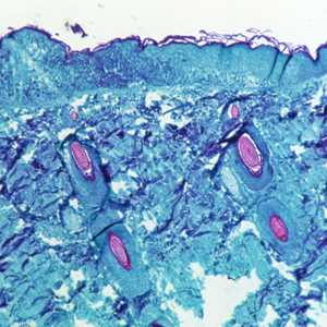 جدري القرود