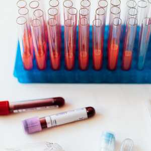 الفحص الجديد يسير بالطريقة التقليدية عبر البحث في الدم.