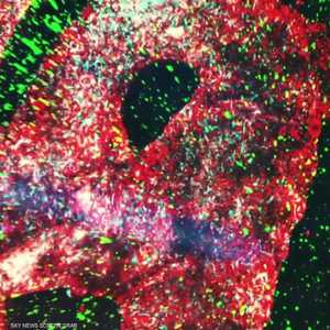 أبحاث طبية: زرع الخلايا الجذعية يعالج سرطان الغدة اللمفاوية