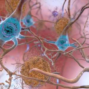 عقار "ليكيمبي" المطور يجدد الأمل في علاج مرض ألزهايمر