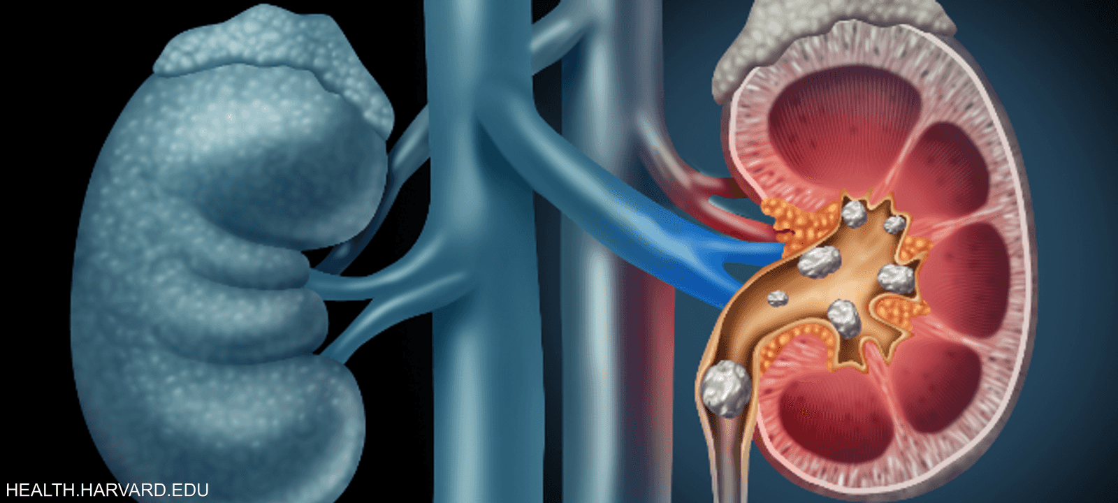 مرض حصى الكلى ترافقه عدة أعراض مؤلمة