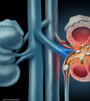مرض حصى الكلى ترافقه عدة أعراض مؤلمة