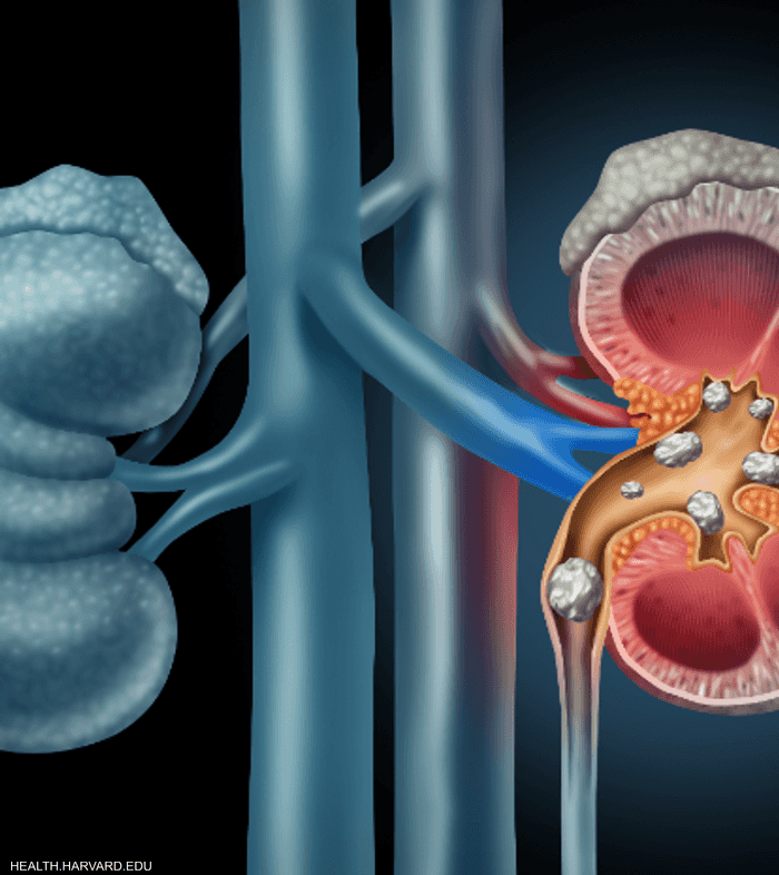 مرض حصى الكلى ترافقه عدة أعراض مؤلمة