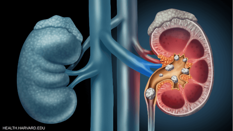 مرض حصى الكلى ترافقه عدة أعراض مؤلمة