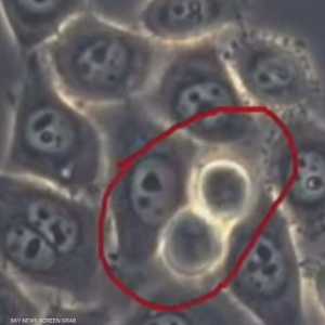 سرطان البنكرياس.. اختبار دم واعد