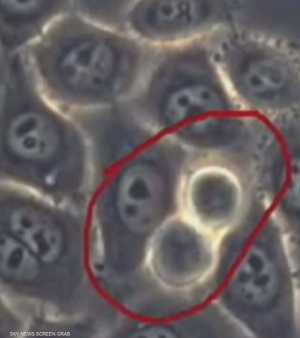 يعد سرطان البنكرياس من أكثر أنواع السرطان فتكا