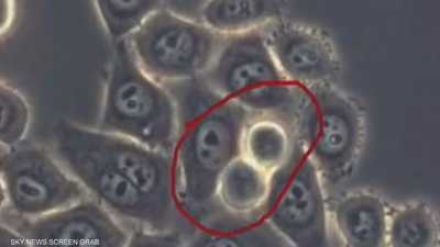 يعد سرطان البنكرياس من أكثر أنواع السرطان فتكا