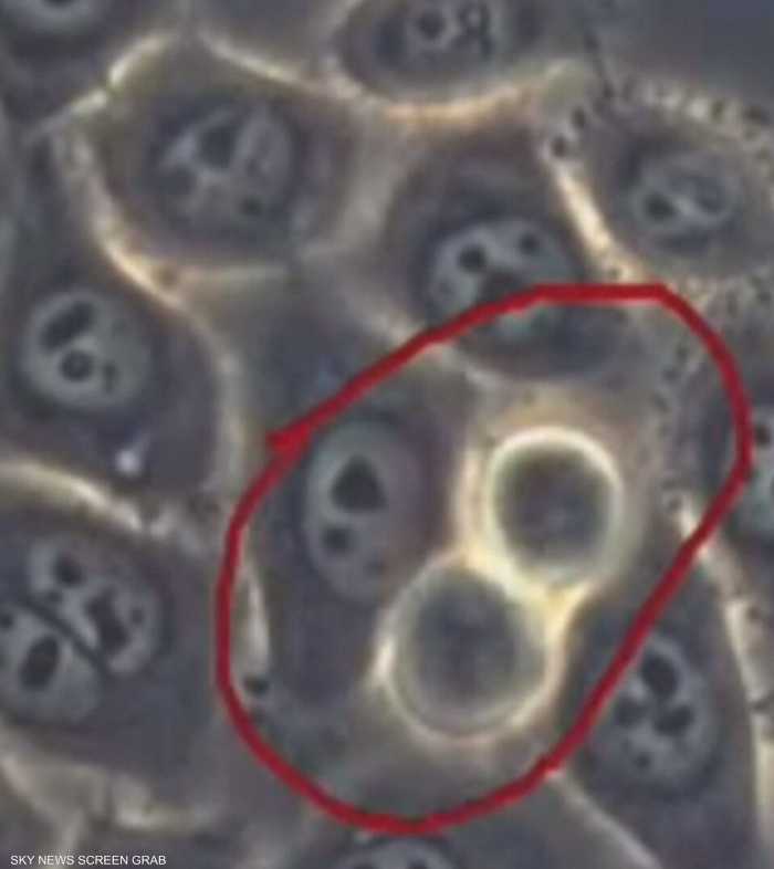 سرطان البنكرياس.. اختبار دم واعد