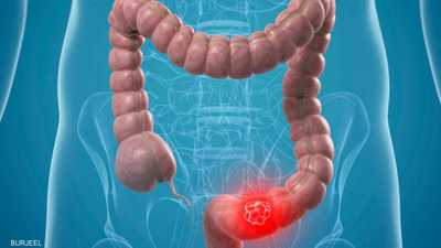 دراسة جديدة تكشف "أكبر عامل خطر" لسرطان القولون لدى الشباب