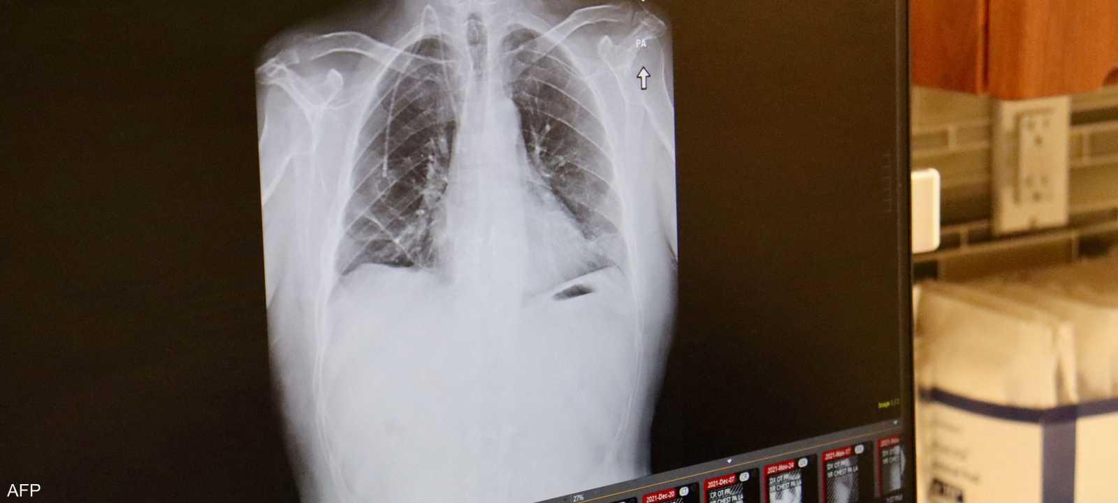 سرطان الرئة يصيب غير المدخنين