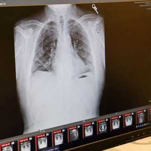 سرطان الرئة يصيب غير المدخنين