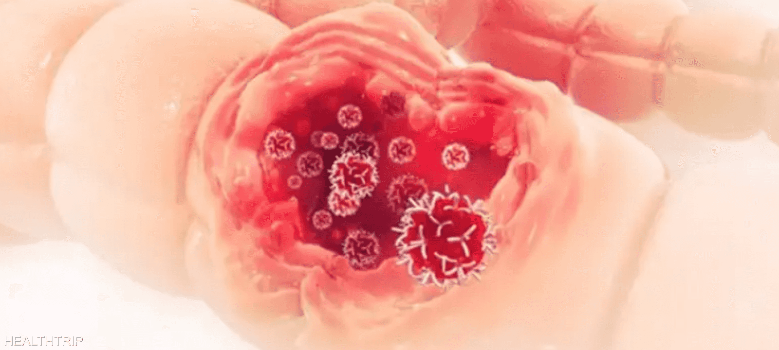 الساركوما هي مجموعة نادرة من الأورام الخبيثة التي تنشأ في ال