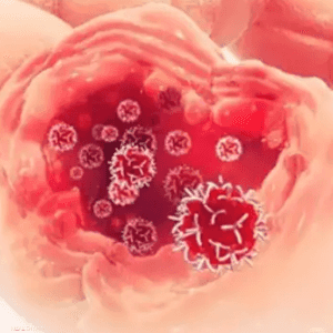 الساركوما هي مجموعة نادرة من الأورام الخبيثة التي تنشأ في ال