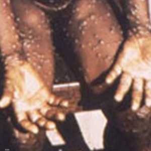 جدري القردة مرض فيروسي يبدأ كرشح ثم يتطور وقد يكون قاتلا