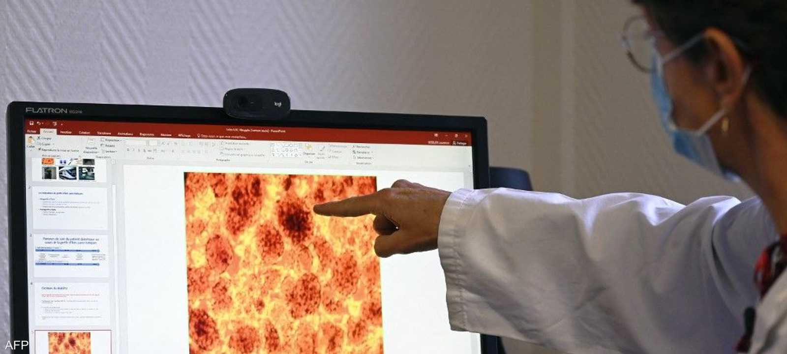 يعتبر سرطان البنكرياس من الأمراض الخطيرة.أرشيفية