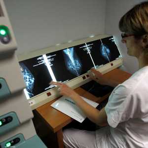 سرطان الثدي