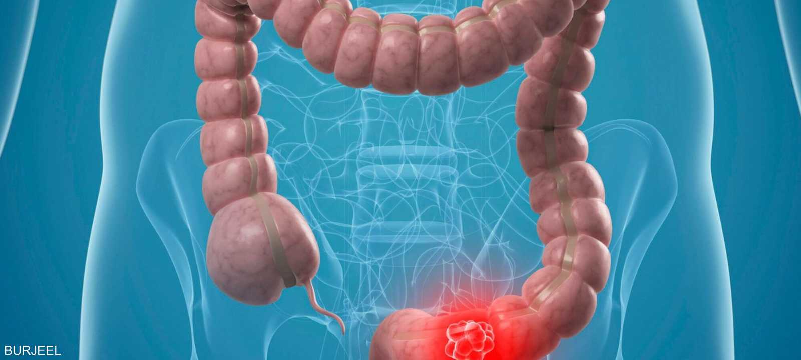 سرطان القولون يزداد بين البالغين