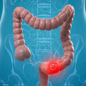 سرطان القولون يزداد بين البالغين