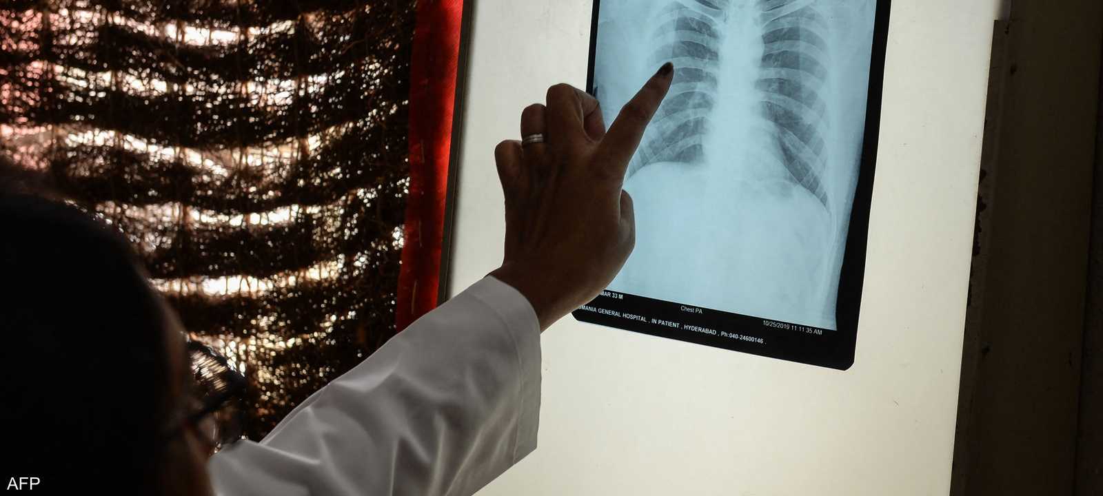 التدخين سبب رئيسي لسرطان الرئة